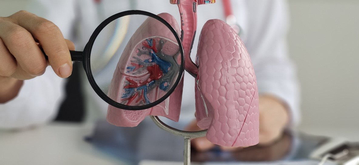 Ιατρικό μοντέλο πνευμόνων που δείχνει τους βρόγχους και τις βρογχεκτασίες, με μεγεθυντικό φακό για την απεικόνιση της διάτασης των αεραγωγών.